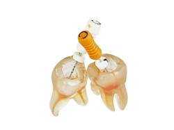 Endo trningov zub 3D